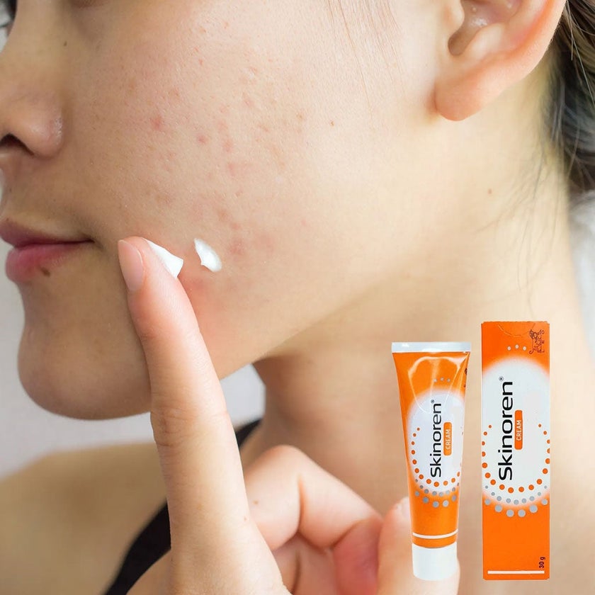 Skinoren Acne Cream 20% – Clear Skin & Spot Removal